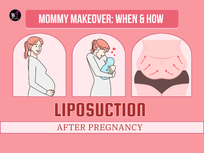 Liposuction After Pregnancy
